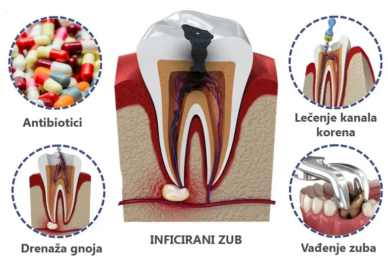 infekcija zuba